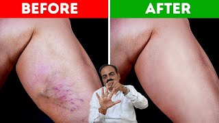 No Tablet  No Surgery  Treat Your Varicose Veins problem Without Any Surgery  Doctor Shiva [upl. by Murdock]