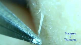 Id Love to Pluck Your Ingrown Hair [upl. by Crutcher803]