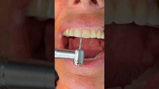 Reshaping Worn  Chipped Teeth After Braces Or Invisalign [upl. by Montford]