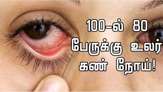 Dry Eyes Home Remedy in Tamil  Dry Eyes Treatment in Tamil  Dry Eyes Symptoms in Tamil [upl. by Alrad]