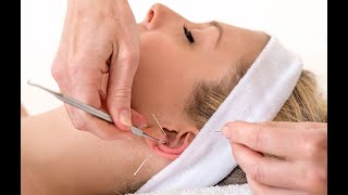 EAR ACUPUNCTURE  AURICULOTHERAPY 05 Auricular Points that Help Lift the Face Naturally [upl. by Ralph]