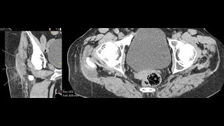 Trochanteric bursitis  CT findings [upl. by Htims931]