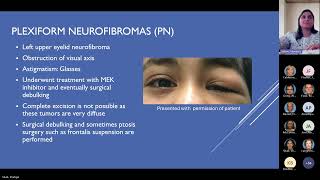 Pediatric Manifestations of Neurofibromatosis Type 1 Pediatric Grand Rounds Meeting 11 15 24 [upl. by Tirza]