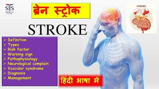 what is stroke full video in Hindi explore stroke brain braintest ischemicstroke [upl. by Onaled]