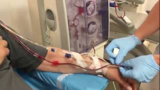 Dialysis connection of a patient with an arteriovenous fistula [upl. by Ilene]