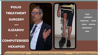 POST POLIO SYNDROME TREATMENT Malignant Multiple Malalignment Syndrome Resolving Hand Thigh Gait [upl. by Seve]