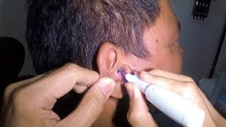 Mans Massive Earwax Extraction [upl. by Leina]