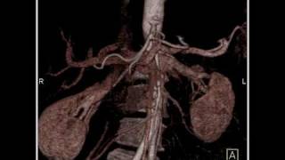 Abdomen Pancreas Staging of pancreatic cancerAnalysis of arterial and venous structures2 of 11 [upl. by Alket]