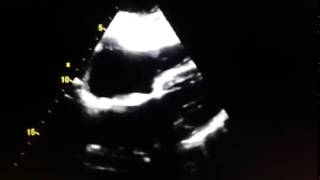 Echocardiogram  lipomatous infiltration of the atrial septum [upl. by Atteval]