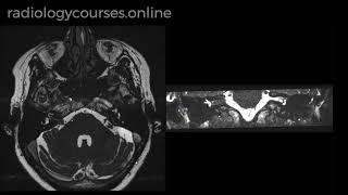 Vestibular Schwannoma [upl. by Aeirdna]