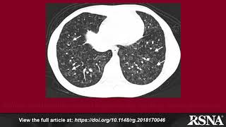 Approach to Pulmonary Hypertension From CT to Clinical Diagnosis [upl. by Ro816]