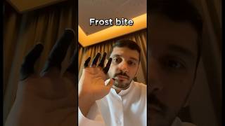 Frost bite 🥶 Explained fahadbadar2 telugu interstingfactsintelugu telugufacts [upl. by Abate740]