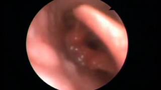 Vocal cord dysfunction syndrome  Video laryngoscopy [upl. by Teresina]