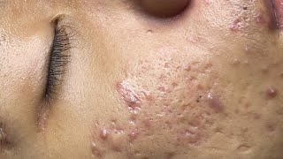 ACNE TREATMENT VU QUYNH MI Acne On Boys Nose 2024 [upl. by Shandeigh]