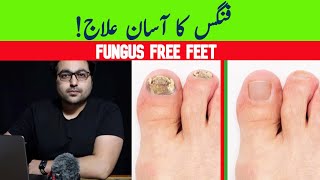 Dr ZeeGet Rid Of Toenail Fungus A complete guide [upl. by Gnol]