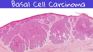 Basal cell carcinoma pathology lectures pathology [upl. by Benjy]