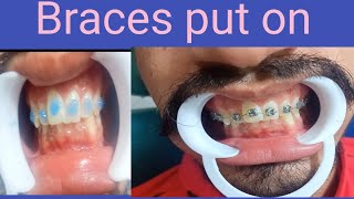 Dental bracesbraces being put on [upl. by Sucramraj]