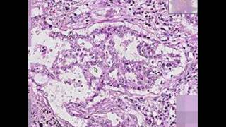 Histopathology Lung Adenocarcinoma [upl. by Rowney802]