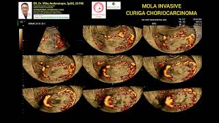 MOLA INVASIVE curiga Choriocarcinoma [upl. by Mcgannon668]