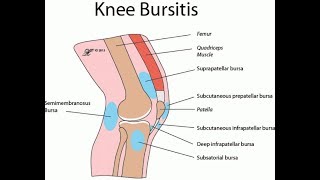 Slijmbeursontsteking knie [upl. by Kimble]