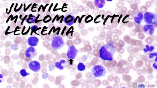 Juvenile Myelomonocytic Leukemia JMML Peripheral Blood Smear 2 year old Hematology amp Hemepath [upl. by Iblehs]