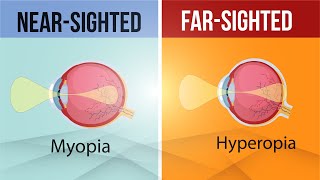 Difference in Myopia and Hyperopia  Nearsighted and FarSighted Lens  Class 10  Letstute CBSE [upl. by Yliab]