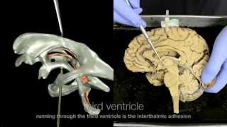 Ventricular System of the Brain [upl. by Treblih]