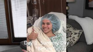 ADULT TONSILLECTOMY SURGERY II DayByDay Recovery the real scoop [upl. by Yuma700]