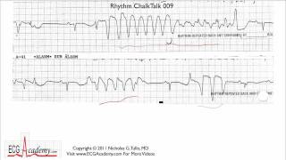 ECG Interpretation Tutorial  ChalkTalk 09  Advanced Level [upl. by Samella195]