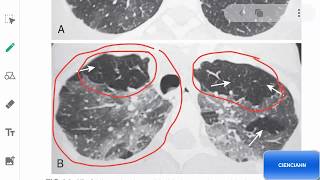 La radiología de la ARTRITIS REUMATOIDE [upl. by Vinita]