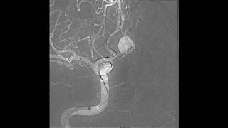 Microcatheter navigation across aneurysm neck [upl. by Skip]