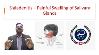 Dr Rudra Mohan  Sialadenitis  Painful Inflammatory Swelling of Salivary Glands [upl. by Je]