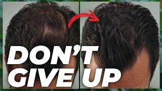 5 Finasteride Alternatives  Watch This if You CANT Use Finasteride [upl. by Kappenne]