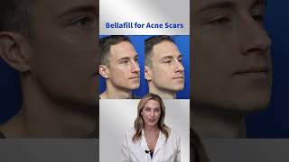 Bellafill for Acne Scars [upl. by Beane]