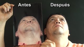 Reconstrucción con Rinoplastia Secundaria e implantes Paranasales Antes y Después Medellin Colombia [upl. by Noirod801]