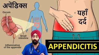 Appendicitis  अपेंडिक्स  Right Lower abdominal Pain  DrEducation [upl. by Turley506]