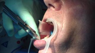 Root canal treatment and tooth damaged repair PART 1 [upl. by Brand]