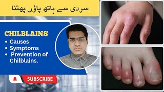 ChilblainsPrenio Treatment and Home Remedies For Chilblains سردیوں میں انگلیوں اور پائوں کی سوزش [upl. by Mayhew465]