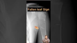 Simple Bone Cyst I ​⁠DrTusharMehta fmge inicet anatomy neetpg [upl. by Marilin]