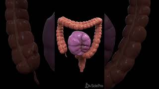 Understanding Colon Volvulus A Twist in the Digestive Tale [upl. by Mars]