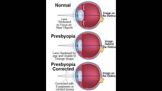 Eye defects and correctness myopia presbyopia shorts science [upl. by Rausch]