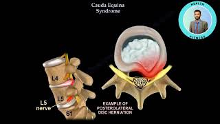 Cauda Equina Syndrom [upl. by Ducan]