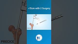 How is limb lengthening surgery performed with Precice 2 [upl. by Eissirhc]