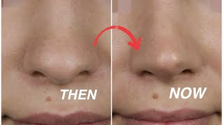 Effective Massage to SLIM YOUR NOSE RESHAPE IT and SHARPEN IT  LETS MAKE OUR NOSE SMALLER [upl. by Phip]