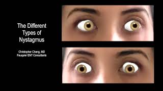 Types of Nystagmus Due to BPPV Vertigo What it Looks Like Which Side amp Which Maneuver [upl. by Nora]