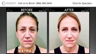 Ultherapy in Princeton NJ Treatment Demo Real Patient Before and After [upl. by Melak]