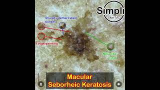 Macular Seborrheic Keratosis Dermoscopy [upl. by Jessa140]