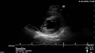 Chapter 7  Hyperdynamic left ventricle PSAX view [upl. by Paderna196]