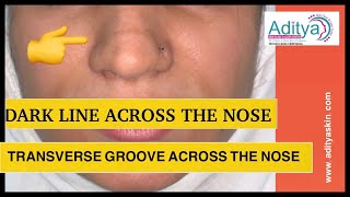 DARK LINE ACROSS THE NOSE  PIGMENTATION ON NOSE  TRANSVERSE NESAL GROOVE  LASER TREATMENT by DR [upl. by Eesac]