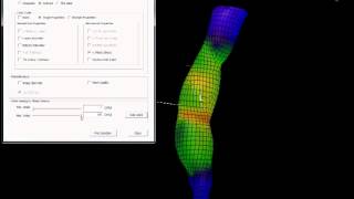 Biomechanical AAA Risk Assessment Part 9  Case demo  Structural analysis with the FEM [upl. by Duffy]